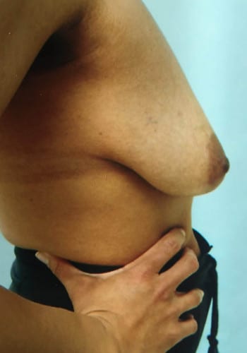 Mastopexy, Breast Augmentation