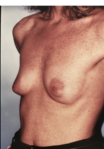 Breast Augmentation