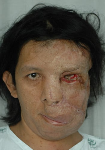 Neurofibromatosis