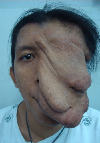 Neurofibromatosis