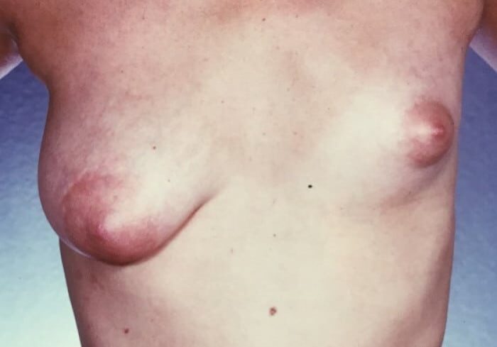 A woman with breast cancer is shown in this picture.