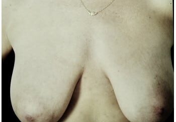 A woman with breast implants is shown in this picture.