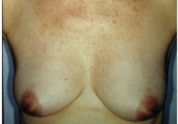 A woman with breast implants is shown in this picture.