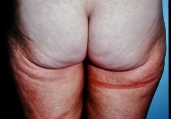 A person with some type of skin disease on their legs.