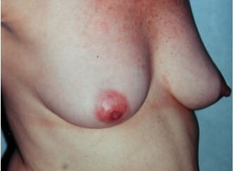 A woman with breast cancer has been diagnosed.