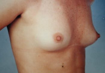 A woman with breast implants is shown in this picture.