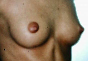 A close up of the breast of a woman