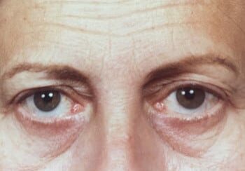 A woman with a large amount of wrinkles on her eyes.