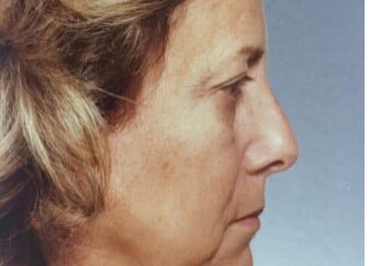 A woman with a facelift on her face.