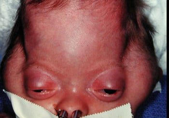 A baby with a fake nose and mouth taped shut.