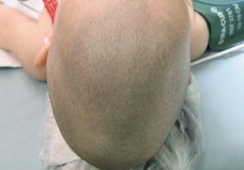 A bald head with a bandage on it's arm.