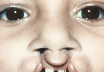 A child with an open mouth and missing teeth.