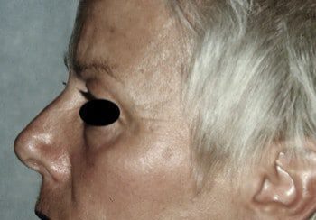 A woman with an eye patch on her nose.