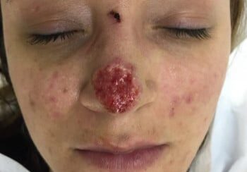 A woman with a red spot on her nose.