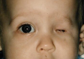 A baby with an eye injury is shown.