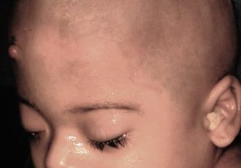 A baby with an ear infection is shown.