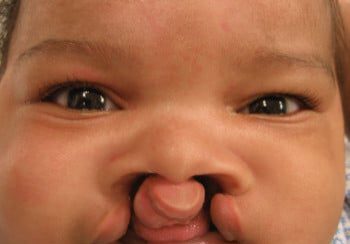 A baby with a large nose and small mouth.