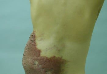 A person with a large scar on their back.