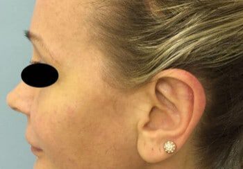 A woman with a black dot on her ear.