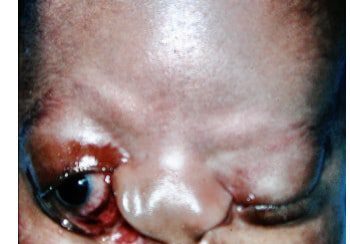 A close up of the face and eyes of an infant.