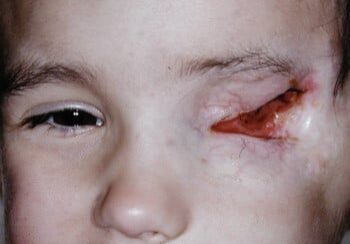 A child with an eye injury and a bite taken out of it.