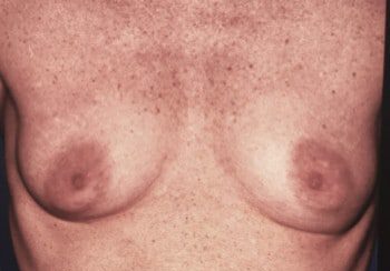 A woman with breast implants is shown in this picture.