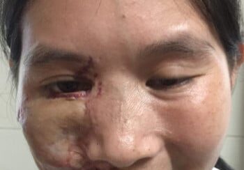 A woman with a bruised face and eye.