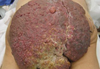 A person with a large, red and brown substance on their stomach.