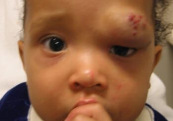 A baby with an injury on its head.