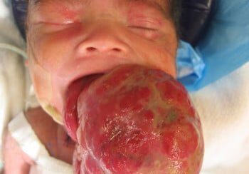 A baby with an open mouth and large blood vessels.