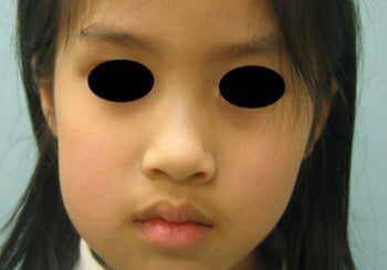 A young girl with two eyes and one eye missing.