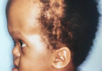 A young child with an unkempt head and hair.