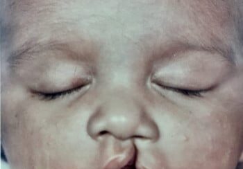 A baby with eyes closed and nose tipped.