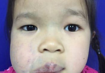 A young girl with a piece of plastic on her cheek.