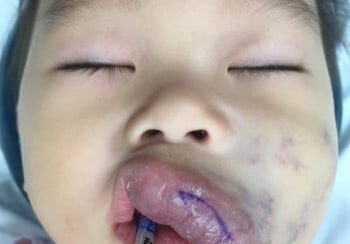 A baby with purple and white spots on its face.