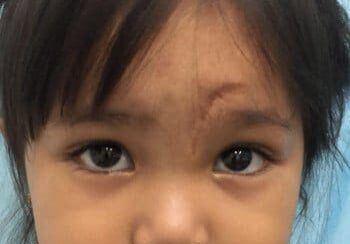 A young child with dark hair and a serious expression looks directly at the camera. The child has a noticeable scar on their forehead and is wearing a colorful shirt.