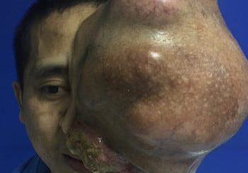 A man with a large tumor on his face.