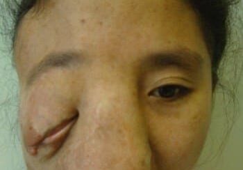 A person with a severe facial deformity, causing significant enlargement around the nose and left eye.