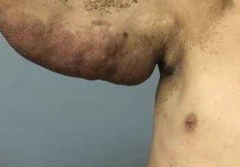 A person's bare upper torso with an abnormally swollen and discolored underarm area against a plain background.