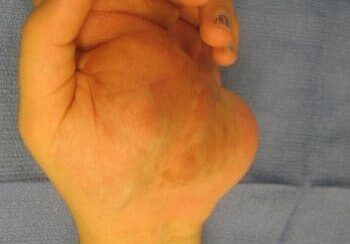 A hand with visible swelling or deformity is resting on a blue fabric surface.