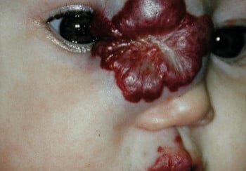 A child with an open mouth and blood on its face.