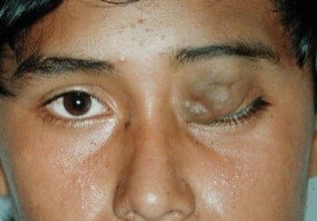 A close-up of a person's face with one eye swollen shut and skin appearing to protrude over the closed eyelid.