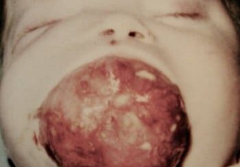 A baby with an open mouth and a large tumor on its face.