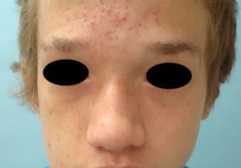 A young man with acne on his face.