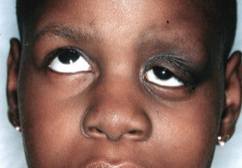 A young boy with black eye makeup and one eye missing.