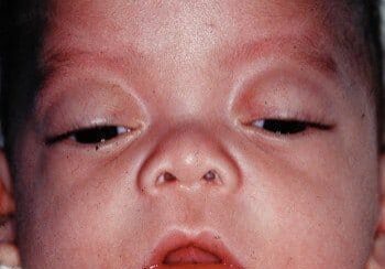 Close-up of an infant's face showing noticeable facial features and expression. The infant's eyes are partially open, and the mouth is slightly ajar. The baby is wearing a white garment.