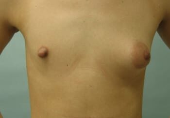 A woman with breast implants is shown in this picture.