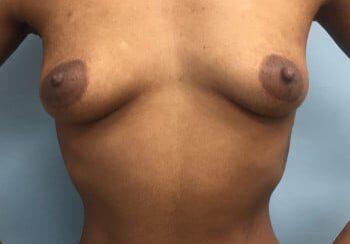 A woman with breast implants is shown in this picture.