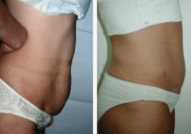 Abdominoplasty-Gallery-Cases-McKinnon-Plastic-Surgery-11-04-2024_11_12_AM