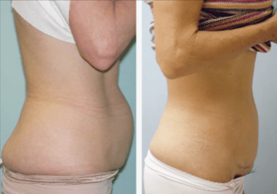 Abdominoplasty-Gallery-Cases-McKinnon-Plastic-Surgery-11-04-2024_11_55_AM